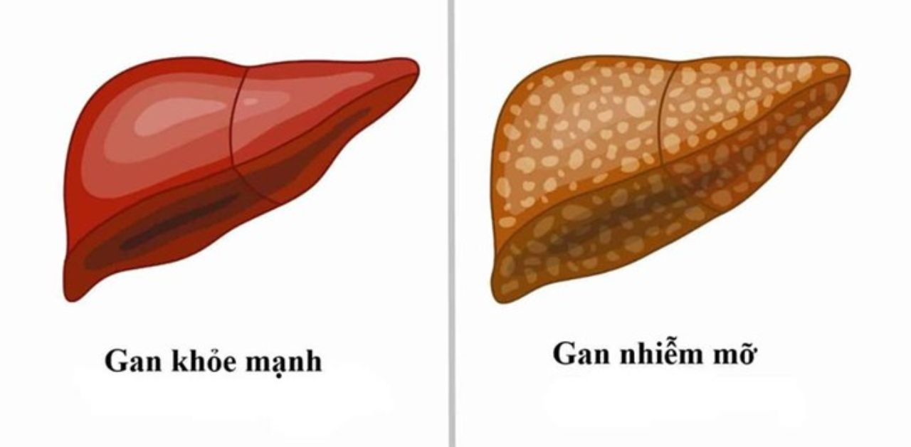 Những nguyên nhân hàng đầu khiến gan bị nhiễm mỡ