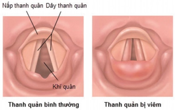 Những nguyên nhân thường gặp gây khàn tiếng