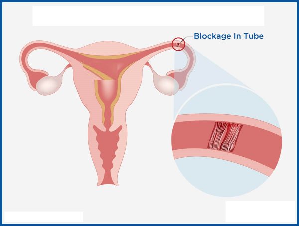 Những phương pháp thông tắc vòi trứng phổ biến hiện nay