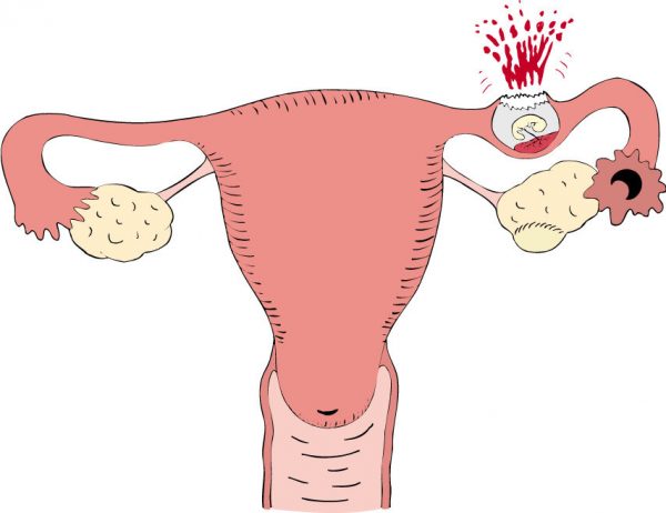 Những phương pháp thông tắc vòi trứng phổ biến hiện nay