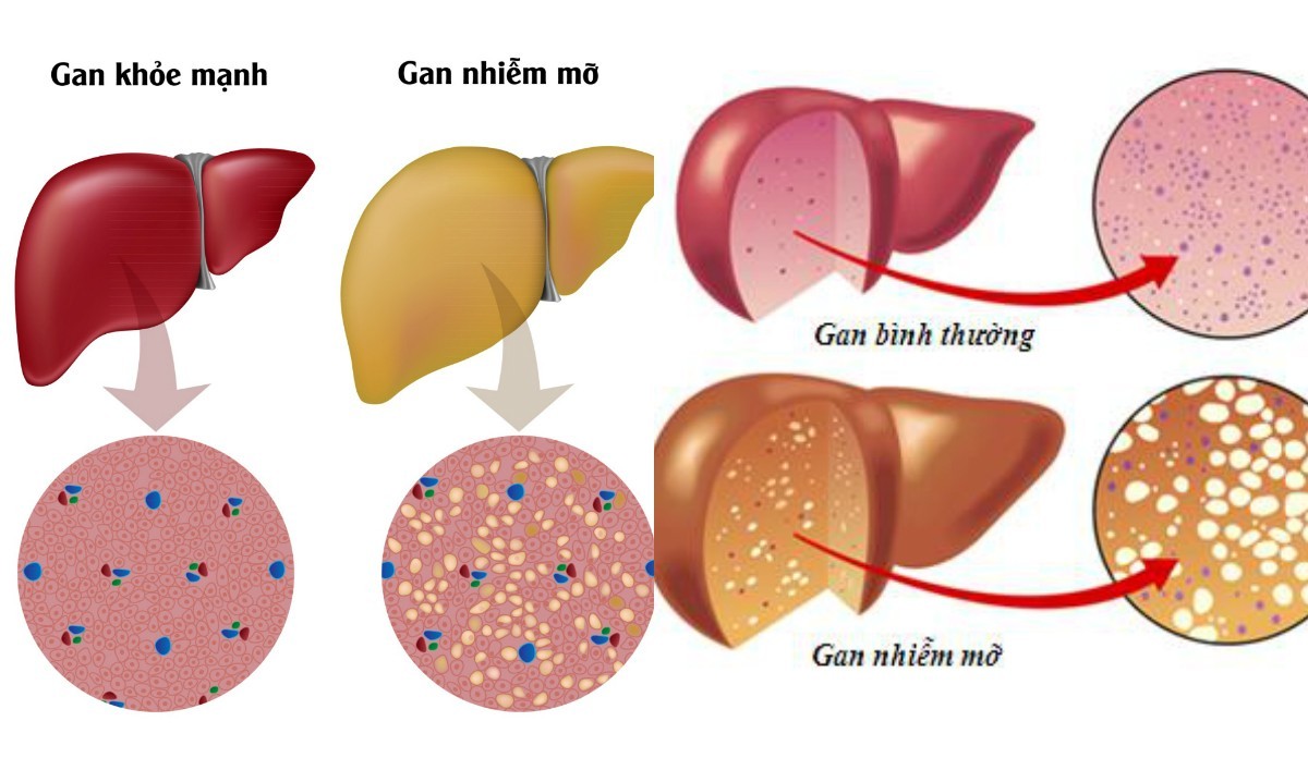 Những quan niệm không đúng về gan nhiễm mỡ