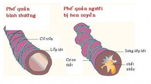 Những sai lầm thường gặp trong điều trị bệnh hen