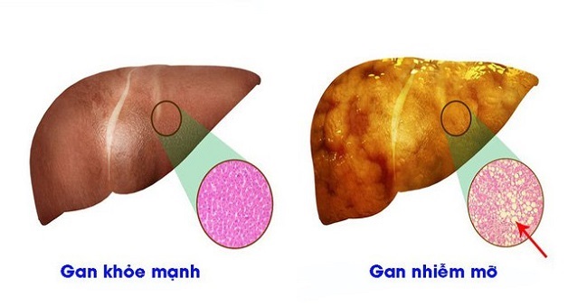 Những tác hại của bệnh gan nhiễm mỡ mà bạn không ngờ tới