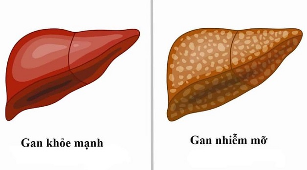 Những tác hại gan nhiễm mỡ và cách giảm nhẹ