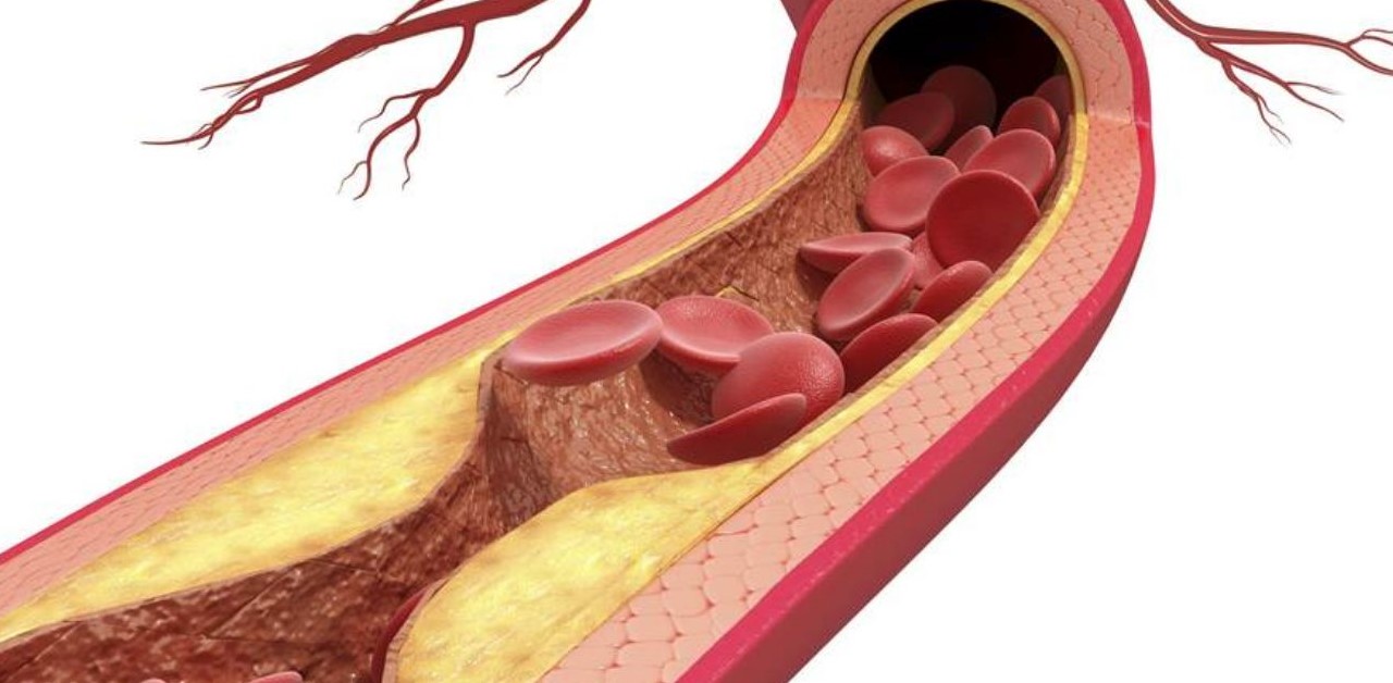 Những thông tin cần biết về bệnh xơ vữa động mạch