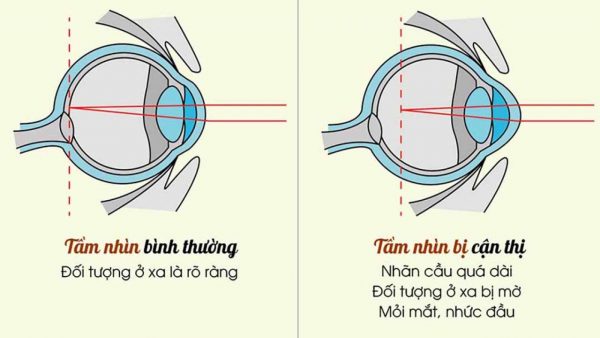 Những thông tin cần biết về thoái hóa võng mạc cận thị