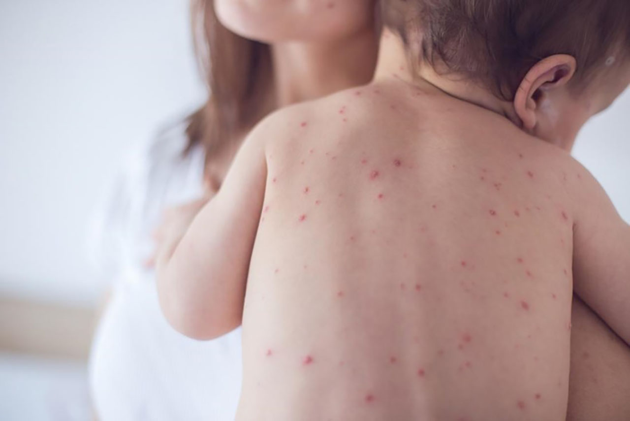 Những thông tin cần biết về vắc xin sởi quai bị Rubella