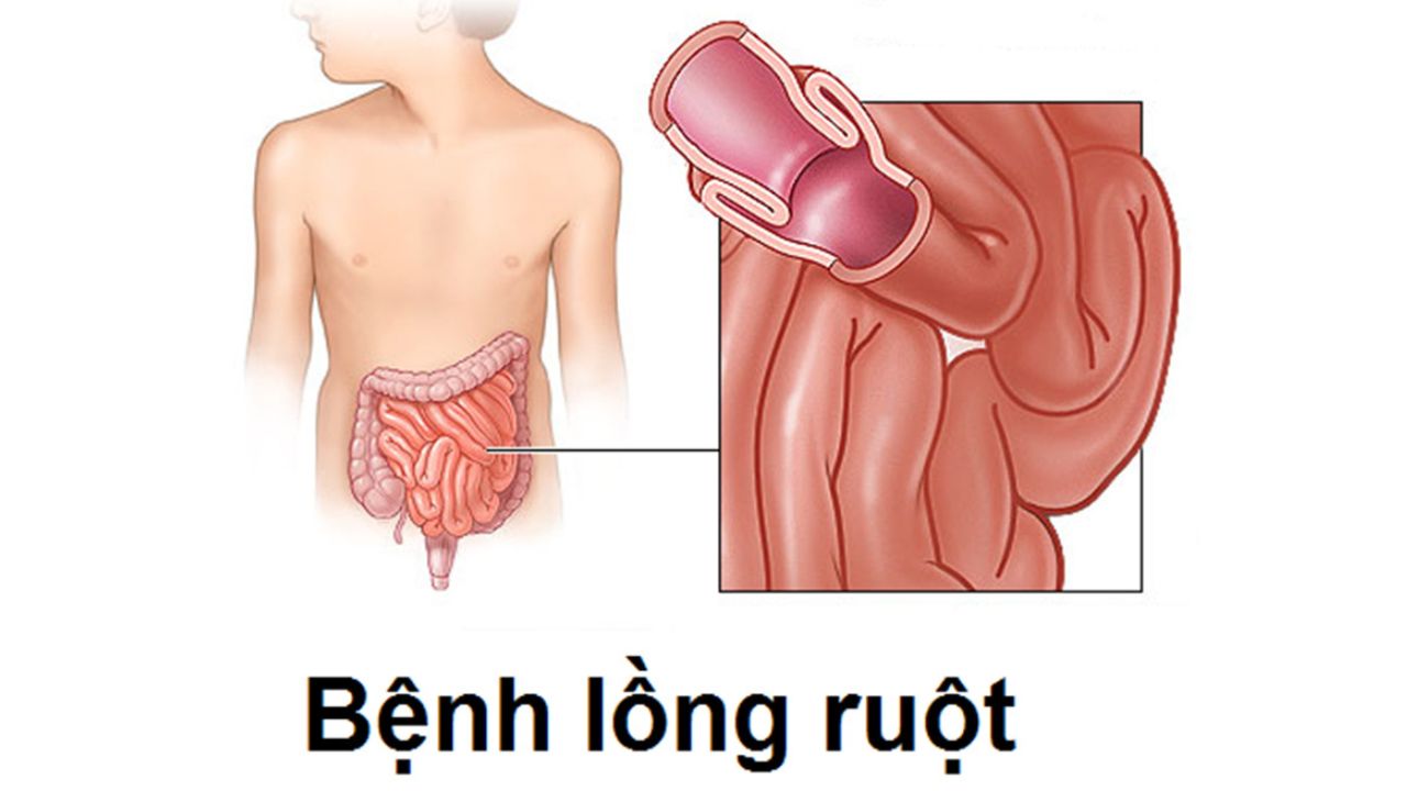 Những thông tin cha mẹ cần biết về lồng ruột ở trẻ em