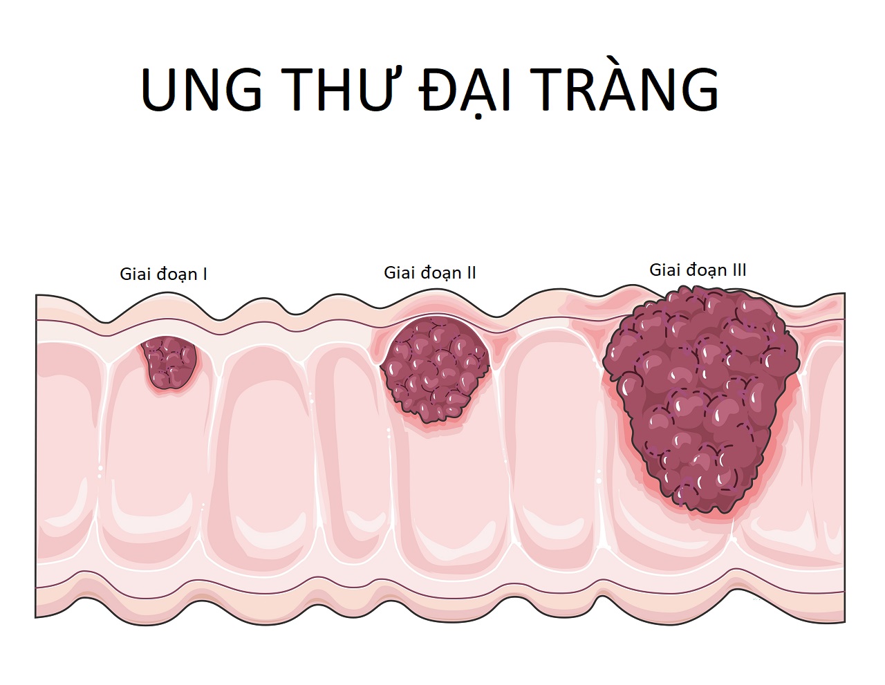 Những thông tin về bệnh ung thư đại tràng giai đoạn 3