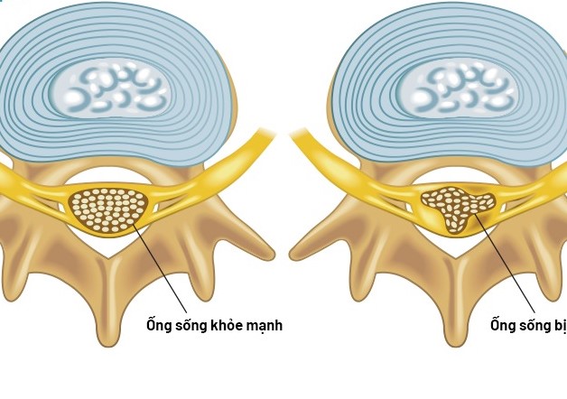 Những thông tin xoay quanh bệnh hẹp đốt sống cổ