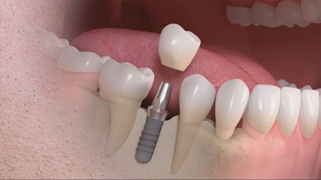 Những tiêu chí cho địa chỉ cấy ghép răng implant uy tín