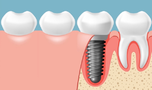 Những tiêu chí cho địa chỉ cấy ghép răng implant uy tín