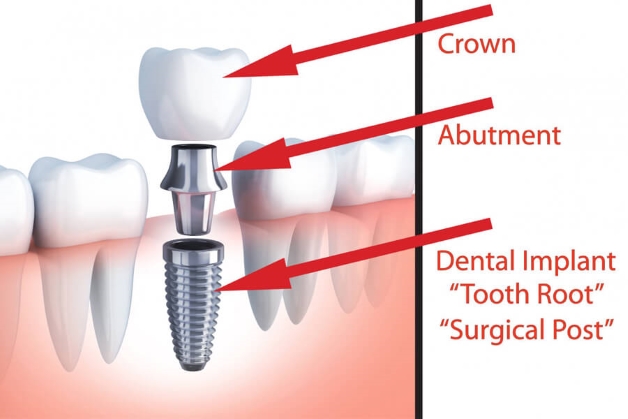 Những tiêu chí cho địa chỉ cấy ghép răng implant uy tín