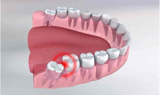 Những tiêu chí cho một địa chỉ nhổ răng khôn uy tín