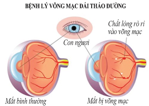 Những triệu chứng bệnh tiểu đường type 2