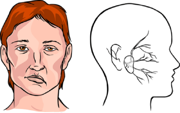 Những triệu chứng đột quỵ nhẹ cần đặc biệt cảnh giác