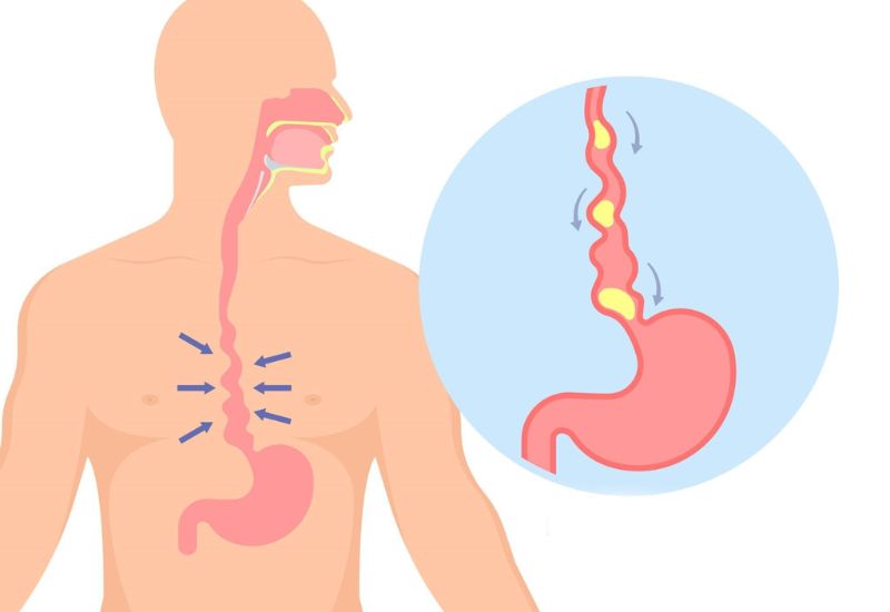 Những triệu chứng trào ngược dạ dày cần lưu tâm