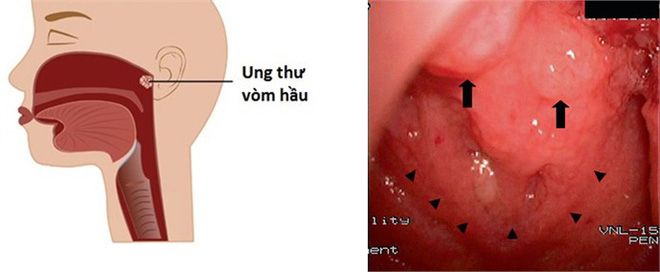 Những triệu chứng ung thư vòm họng không nên bỏ qua