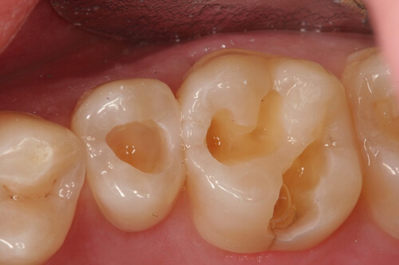 Những trường hợp có thể hàn trám răng sâu lỗ to