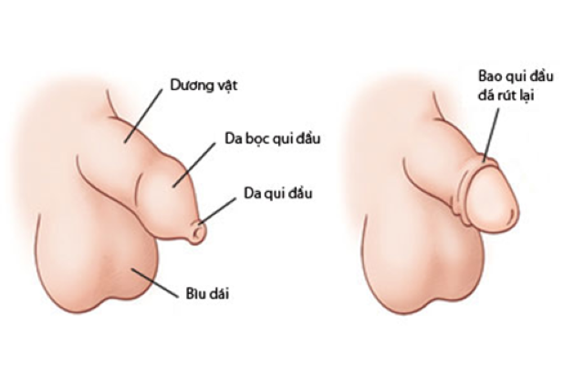 Những trường hợp nào nên thực hiện cắt bao quy đầu trẻ em?