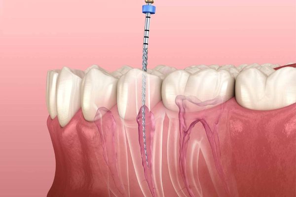 Những vấn đề cần lưu ý khi điều trị tủy răng