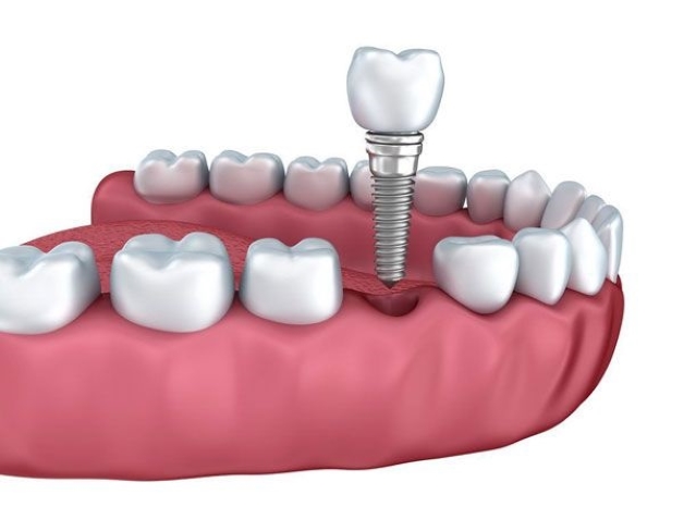 Những vấn đề khi nhổ răng số 5