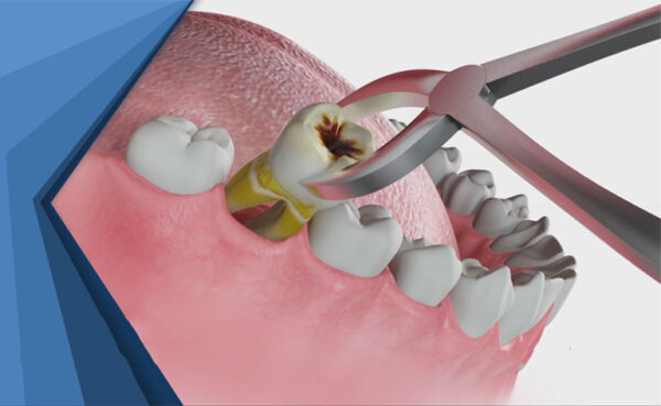 Những việc cần phải làm khi bị sâu răng cấm