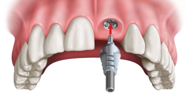 Những yếu tố ảnh hưởng tới giá trồng răng sứ