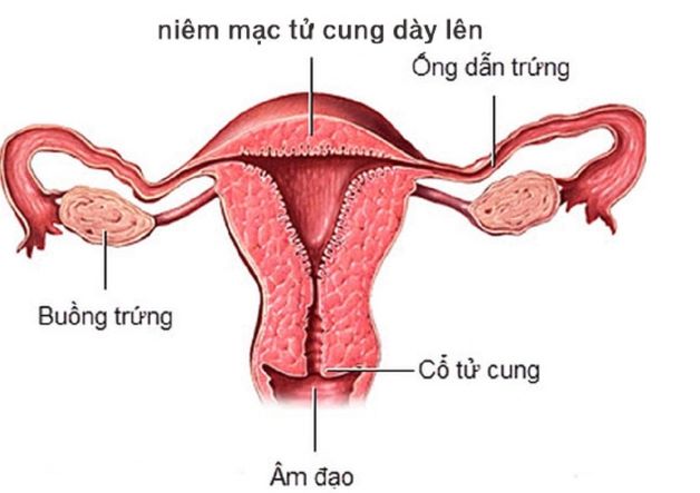 Niêm mạc tử cung dày có ảnh hưởng gì không?