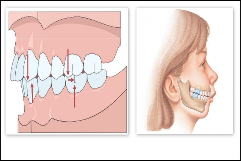 Niềng răng hô hàm trên – Những thông tin cần thiết