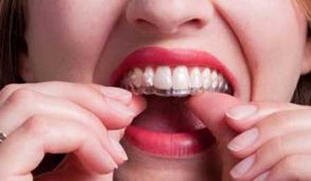 Niềng răng invisalign có đau không?