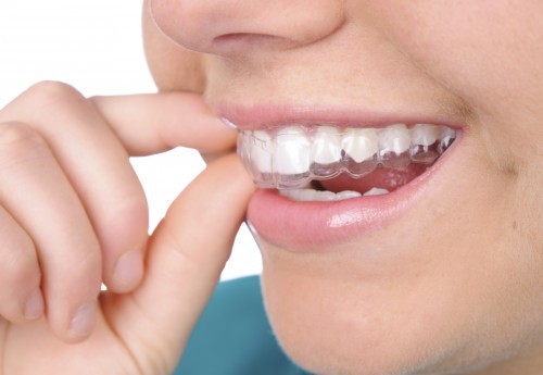 Niềng răng invisalign có đau không?