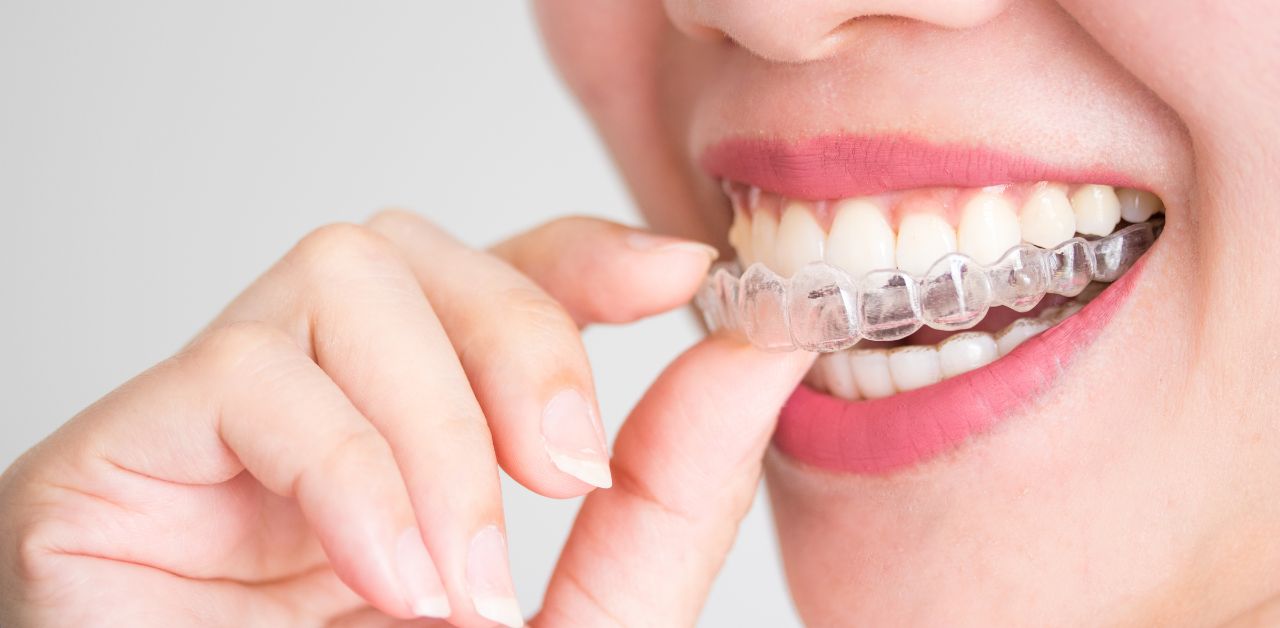 Niềng răng invisalign đặc biệt tại các nước phát triển