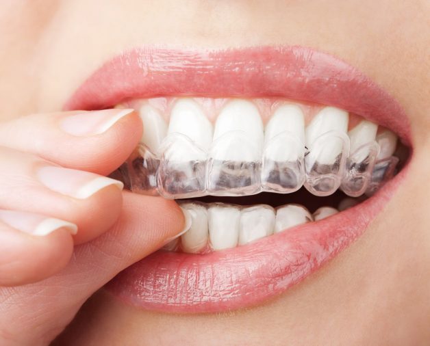 Niềng răng Invisalign được tiến hành như thế nào?