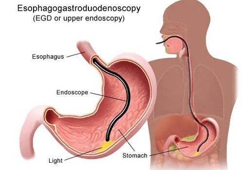 Nội soi dạ dày cần chuẩn bị gì?