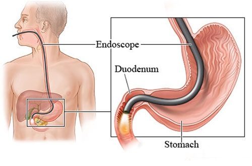 Nội soi dạ dày có lây bệnh không?