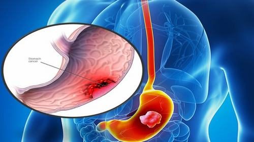 Nội soi dạ dày có phát hiện ung thư không?