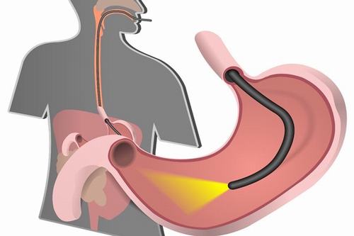 Nội soi dạ dày không đau hiệu quả thế nào?