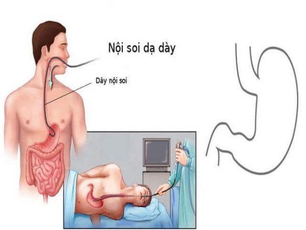 Nội soi dạ dày không đau ở đâu?