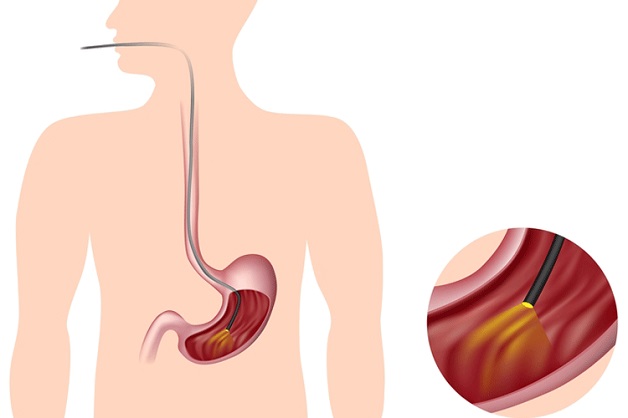 Nội soi dạ dày là gì? Những điều cần lưu ý khi thực hiện