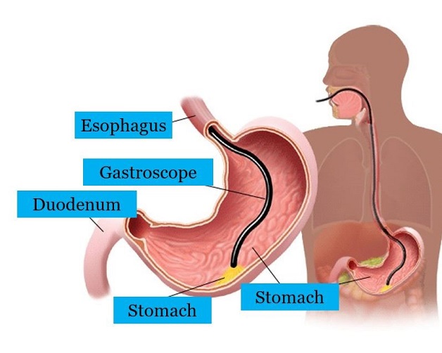 Nội soi dạ dày là gì? Những điều cần lưu ý khi thực hiện