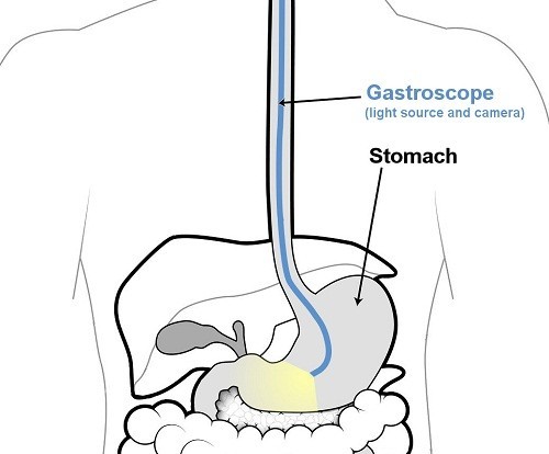 Nội soi dạ dày là gì? quan sát bên trong ống tiêu hóa