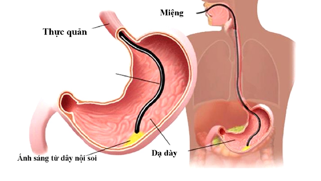 Nội soi dạ dày là gì và các vấn đề liên quan