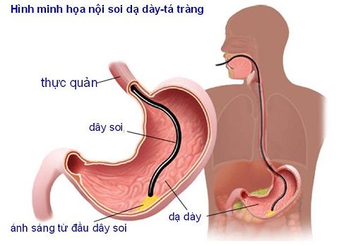 Nội soi dạ dày tá tràng