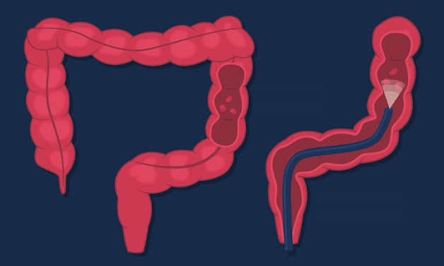 Nội soi đại tràng có đau không và những ai cần thực hiện?