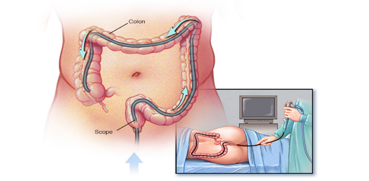 Nội soi đại tràng mất bao lâu và được thực hiện như thế nào?