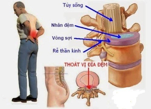 Nội soi điều trị thoát vị đĩa đệm ít làm ảnh hưởng