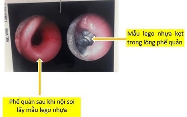 Nội soi gắp dị vật trong phế quản giải quyết hóc