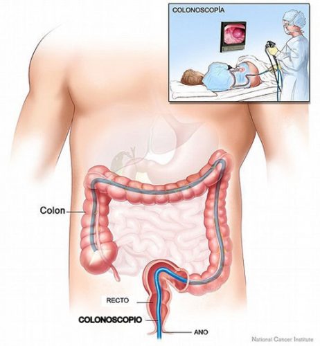 Nội soi gây mê là gì?