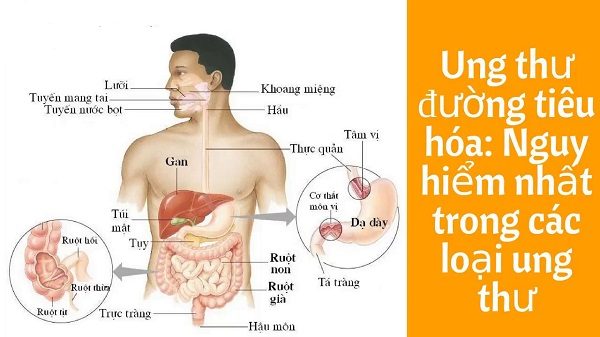 Nội soi giúp phát hiện bộ 3 ung thư ở đường tiêu hóa